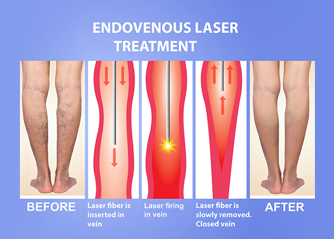 Laser Venous Ablation Wisconsin Veins