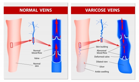 Varicose veins vs normal veins