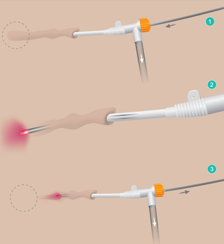 Laser venous ablation sheath insertion