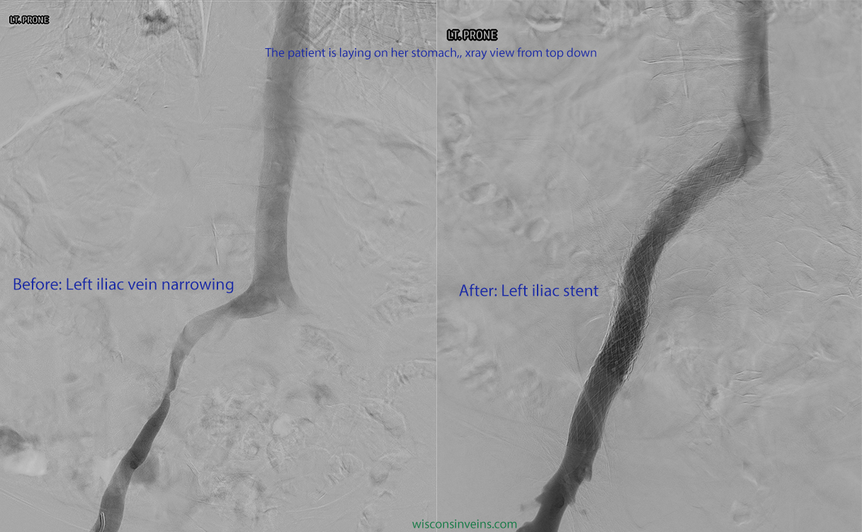 Example of May-Thurner Syndrome treatment with left iliac vein stent