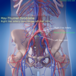 May-Thurner Syndrome Anatomy
