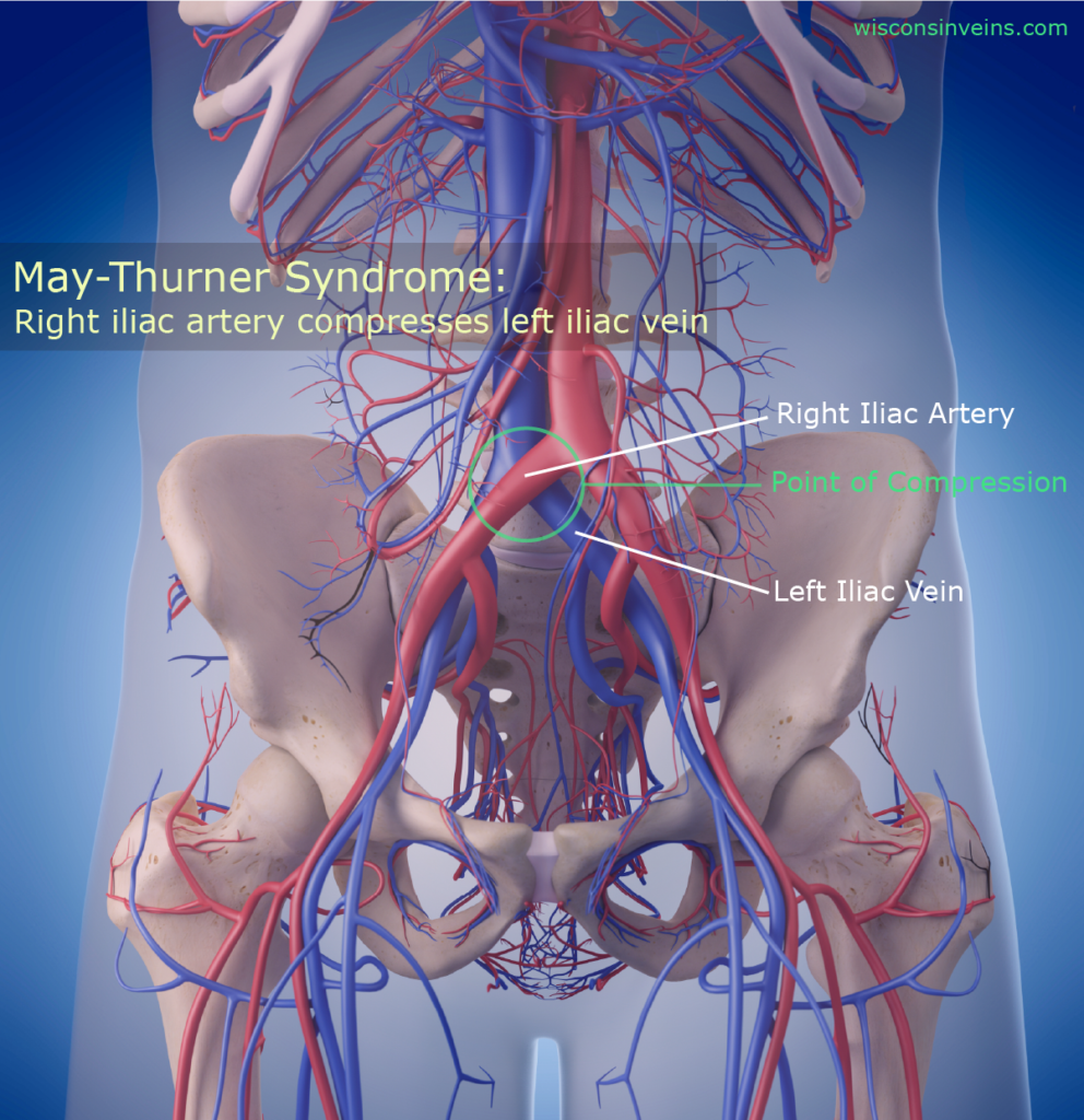 May-Thurner Syndrome Anatomy