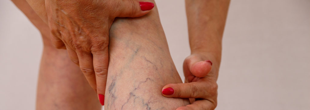 Painful spider veins