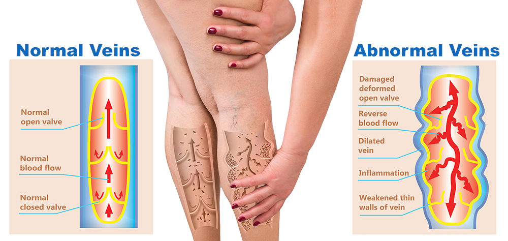 Varicose veins illustrations