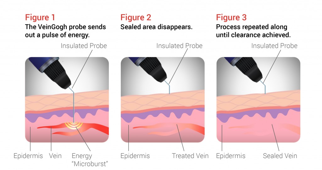 VeinGogh Procedure Diagram