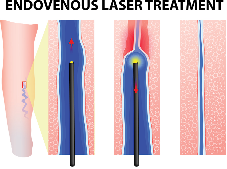 Laser venous ablation steps