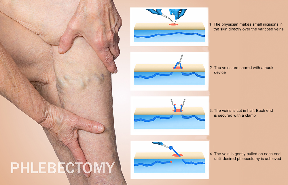 Microphlebectomy