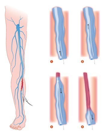 Radiofrequency Venous Ablation