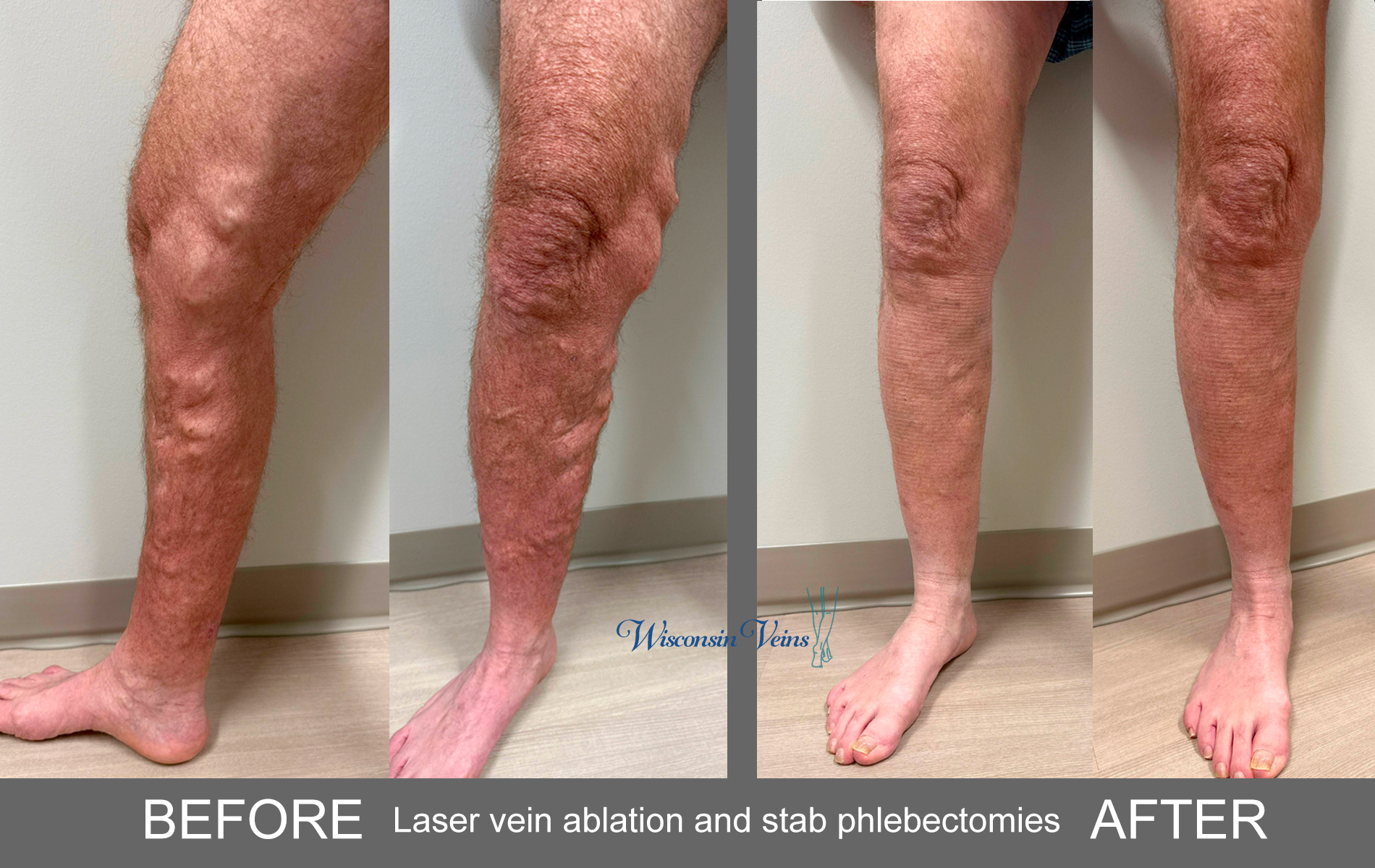 Laser venous ablation and stab phlebectomies before and after treatment pictures