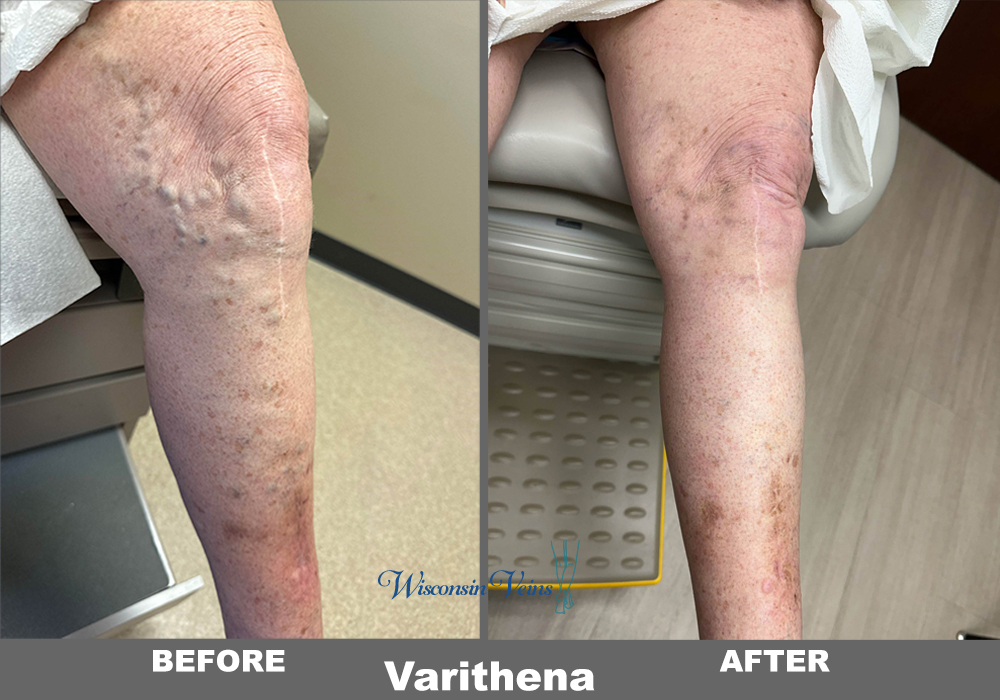 Varithena before and after